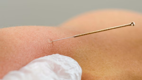 Dry Needling