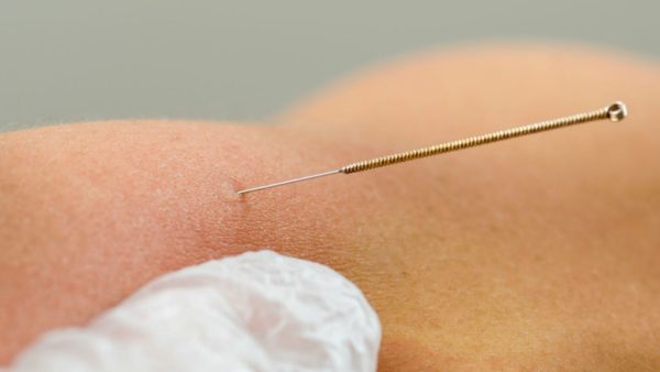 nowweb-fysiotherapie-richard-van-putten-dry-needling