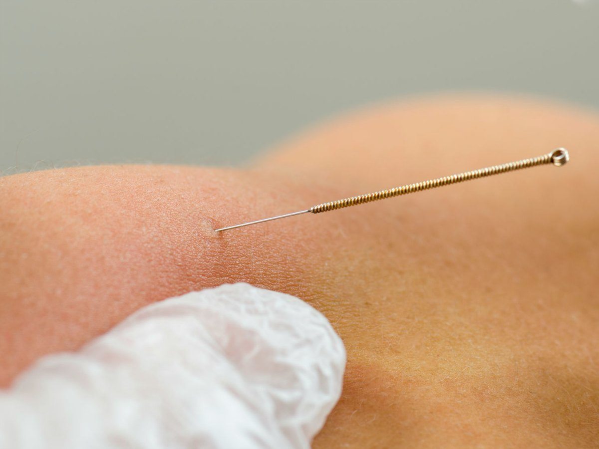 Dry Needling